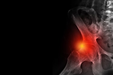 Impacto Femoroacetabular | Dr. Daniel Daniachi