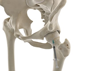 Infiltração intra-articular de Quadril | Dr. Daniel Daniachi