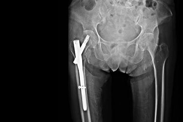 Tratamento Cirúrgico de Fratura do Fêmur Proximal