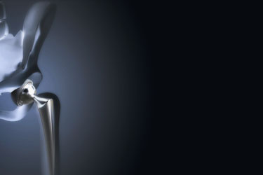 Prótese de Quadril (artroplastia): cirurgia, tipos e recuperação